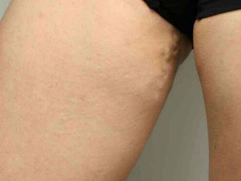 kŕčové žily panvy počas tehotenstva